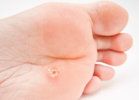 Verrue de type HPV1 dite myrmécie